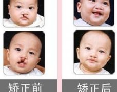 吃兔肉真的會(huì)長(zhǎng)兔唇？為什么會(huì)長(zhǎng)兔唇？